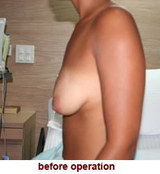 plastic-surgery-breast-lift-augmentation